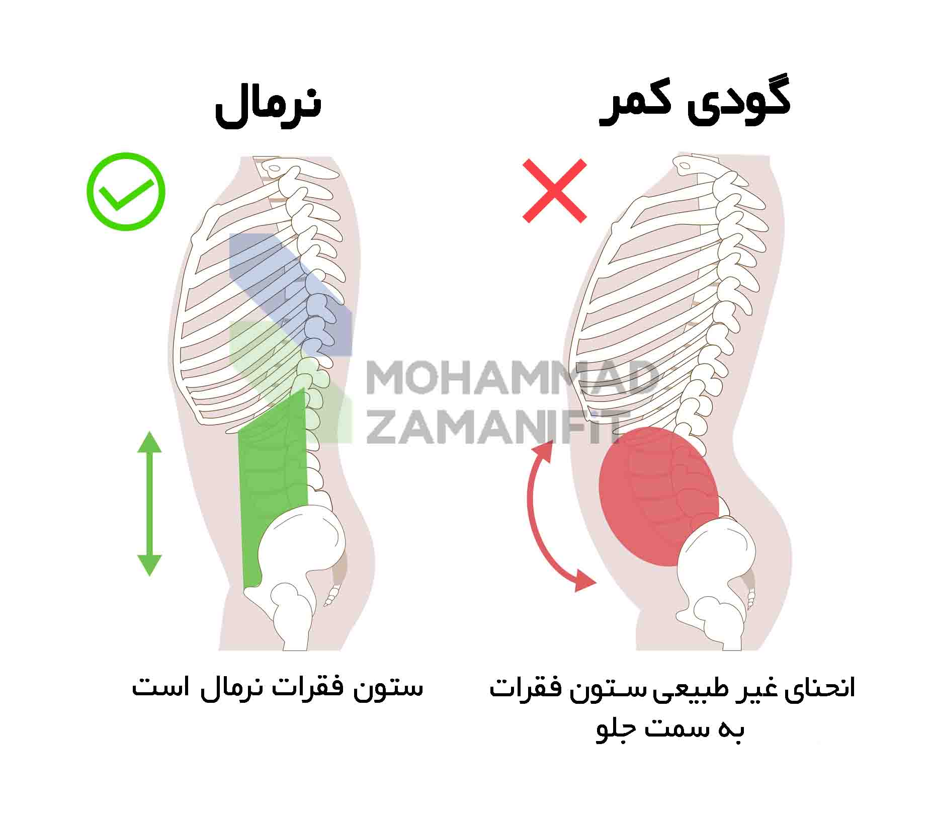 گودی کمر یا لوردوز عارضه‌ای است که انحنای طبیعی کمر بیش از حد معمول باشد و با مشکلاتی مثل درد و ضعف عضلانی همراه است که در این مقاله درمان گودی کمر را آموزش داده‌ام.