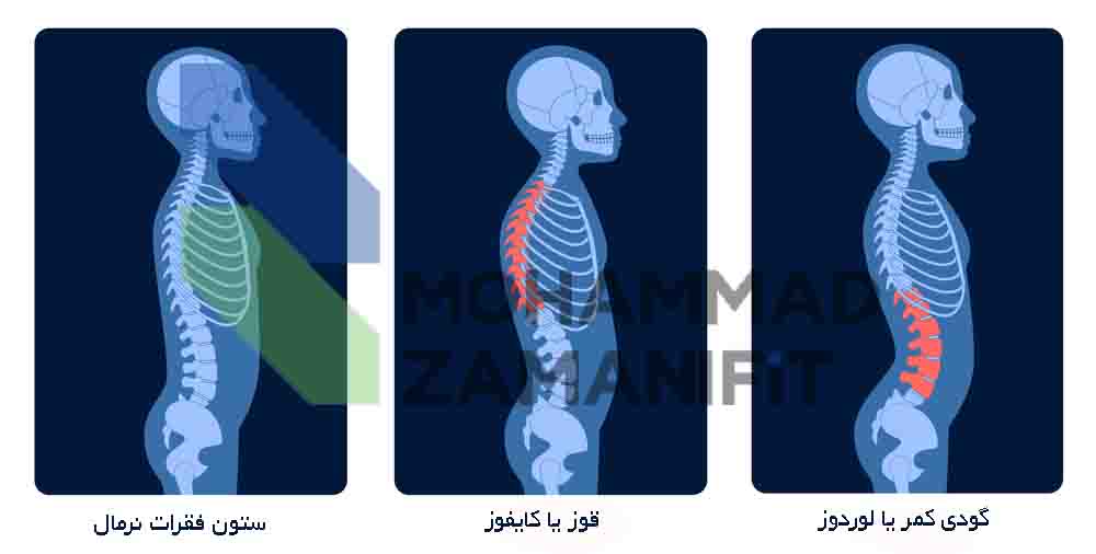 گودی کمر یا لوردوز عارضه‌ای است که انحنای طبیعی کمر بیش از حد معمول باشد و با مشکلاتی مثل درد و ضعف عضلانی همراه است که در این مقاله درمان گودی کمر را آموزش داده‌ام.