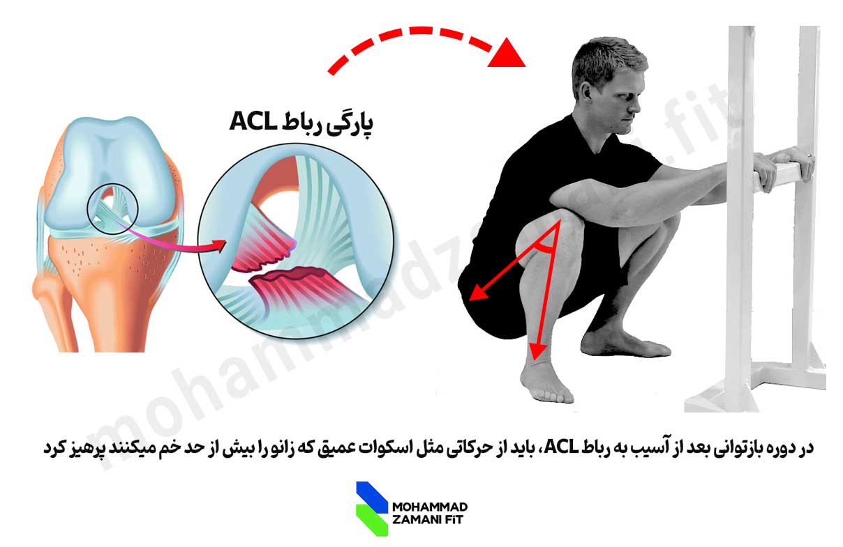 در پارگی ACL نباید حرکاتی انجام داد که زانو بیش از حد خم می‌شود